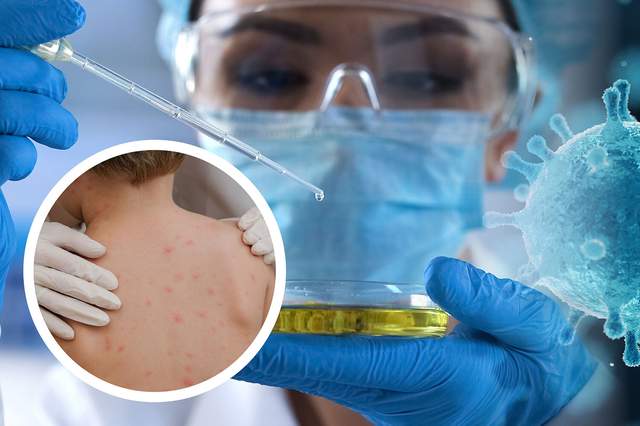 Παγκόσμιο συναγερμό για την ευλογιά των πιθήκων κήρυξε ο ΠΟΥ – Αυξημένος ο κύνδυνος στην Ευρώπη
